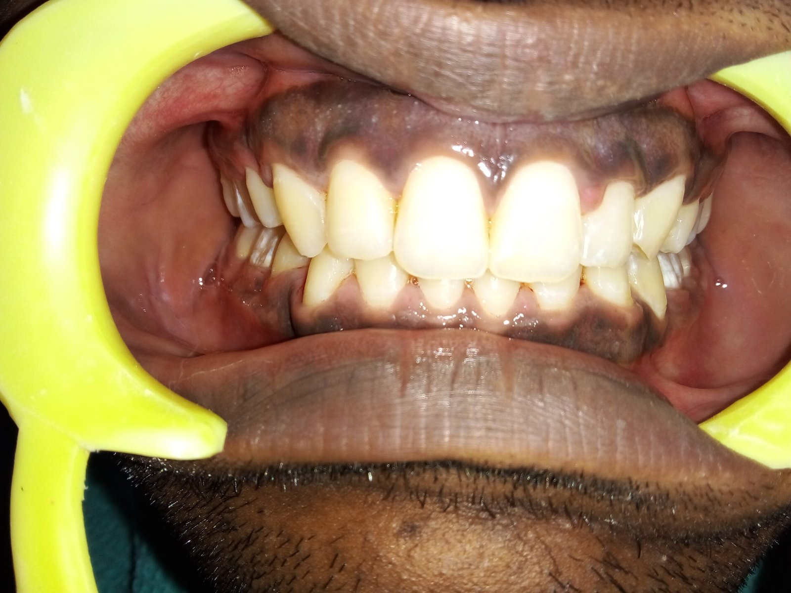 Orthodontic Treatment after coming to the best Madras Dental Clinic in Anna Nagar