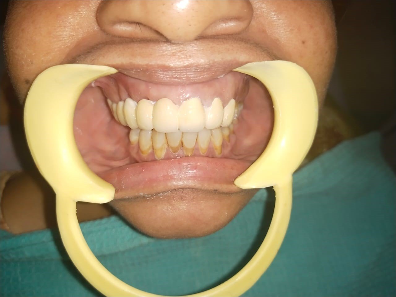 Proclined upper fronttooth with root exposure after coming to the best Madras Dental Clinic in Anna Nagar