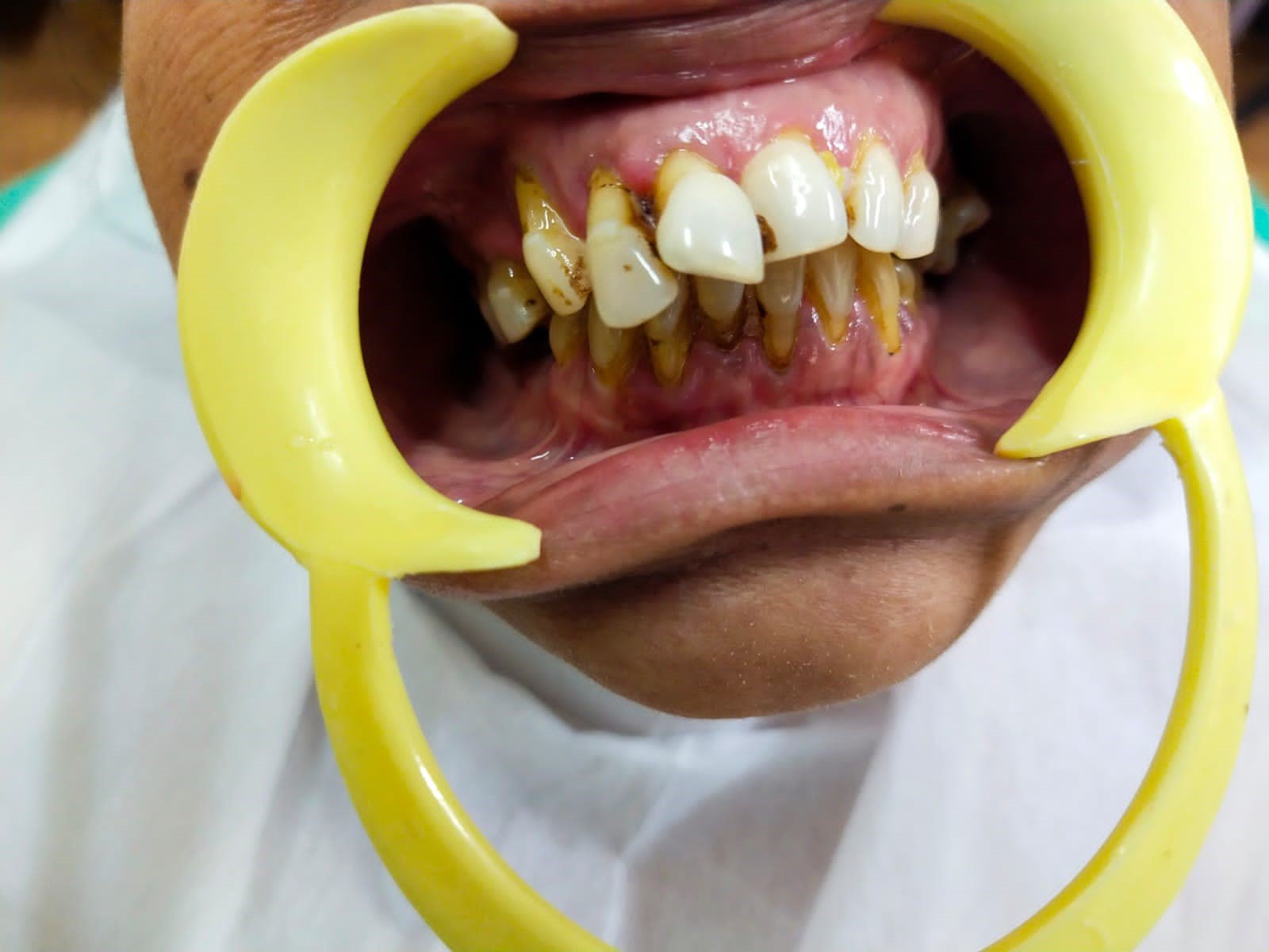 Proclined upper fronttooth with root exposure before coming to the best Madras Dental Clinic in Anna Nagar